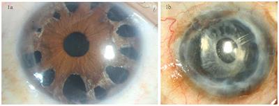 Spokewise iridotomy combined with Descemet stripping automated endothelial keratoplasty in iridocorneal endothelial syndrome